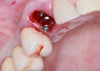 Foto implante instalado 03-10-16 - Clínica Cliniface