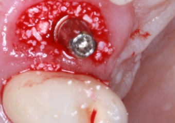 Foto implante   enxerto Bio Oss 03-10-16 - Clínica Cliniface