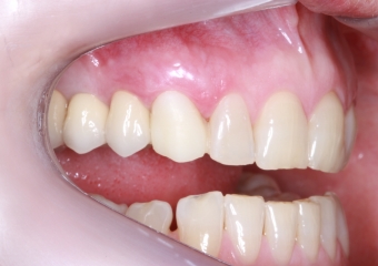 Foto provisorio controle de 7 dias 10-10-16 - Clínica Cliniface