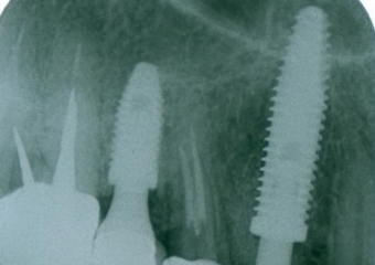 Rx Periapical controle 1 mes 21-11-16 - Clínica Cliniface