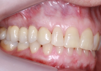 Foto lateral com protese definitiva 22-08-17 - Clínica Cliniface