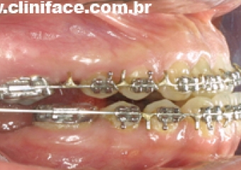 Imagem mordida de perfil inicial  - Clínica Cliniface