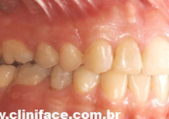  Imagem mordida após remoção do aparelho - Clínica Cliniface