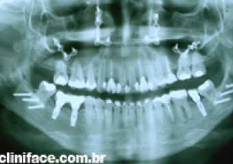 Raio x panorâmico final - Clínica Cliniface