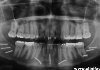 Raio x panorâmico final          - Clínica Cliniface