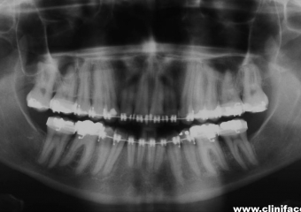 Raio x panorâmico inicial - Clínica Cliniface