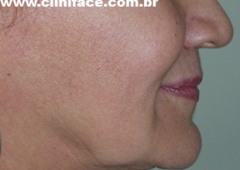 Imagem perfil após instalação da fixa provisória - Clínica Cliniface