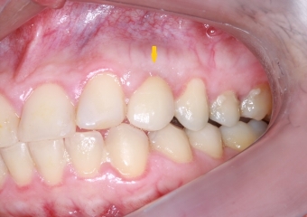 Janeiro de 2016, Controle de 3 anos - Clínica Cliniface