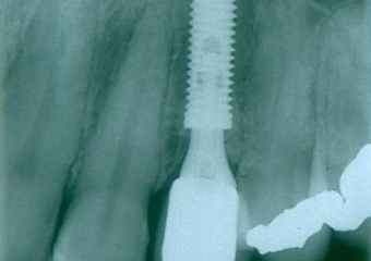 Janeiro de 2016, Controle de 3 anos - Clínica Cliniface