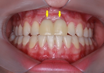 Protese Provisória sobre os implantes - Clínica Cliniface