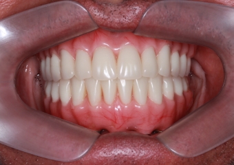 Prótese fixa sobre os implantes inferiores e nova prótese total superior, em Janeiro de 2016 - Clínica Cliniface