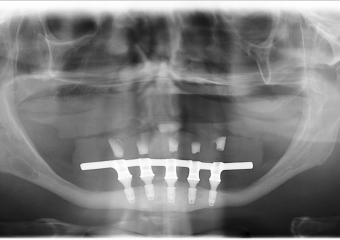 Raio-x Implantes com Prótese Fixa Definitiva em Resina  - Clínica Cliniface