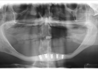Raio - x Panorâmico Implantes inferiores instalados, em Outubro de 2015 - Clínica Cliniface