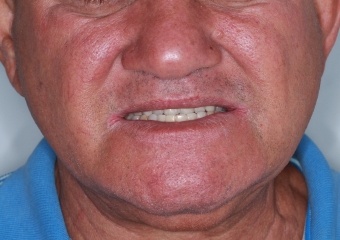 Sorriso inicial, em 2015 - Clínica Cliniface