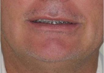 Sorriso inicial - Clínica Cliniface