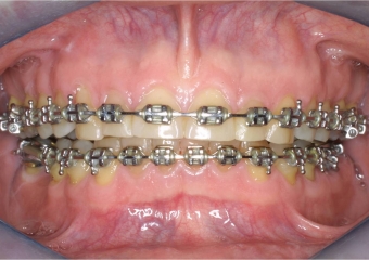 Mordida inicial - Clínica Cliniface