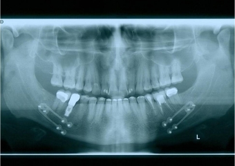 Raio x de controle, 3 anos após a cirurgia - Clínica Cliniface