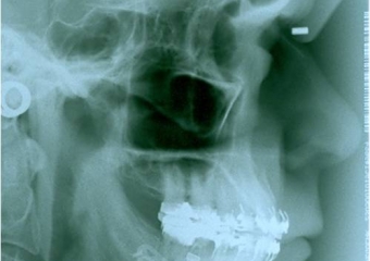 Telerradiografia após a cirurgia - Clínica Cliniface