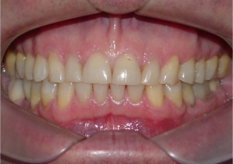 Mordida, após 2 anos da cirurgia - Clínica Cliniface