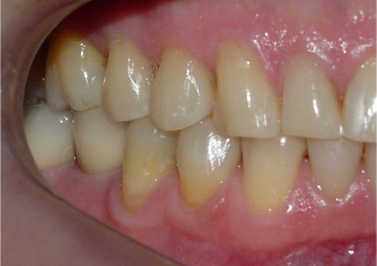 Mordida, após 2 anos da cirurgia - Clínica Cliniface