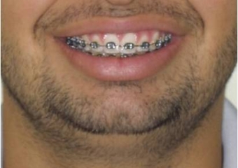 Sorriso inicial - Clínica Cliniface