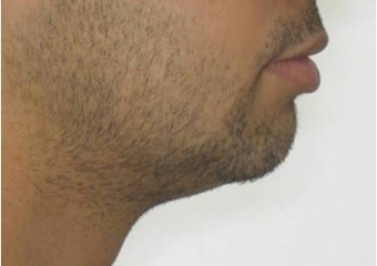 Perfil após cirurgia - Clínica Cliniface