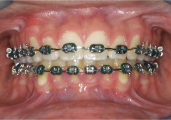 Mordida inicial - Clínica Cliniface