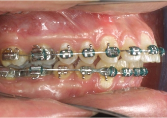 Mordida inicial - Clínica Cliniface