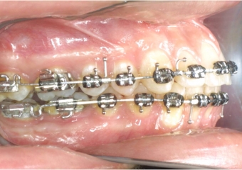 Mordida após cirurgia - Clínica Cliniface