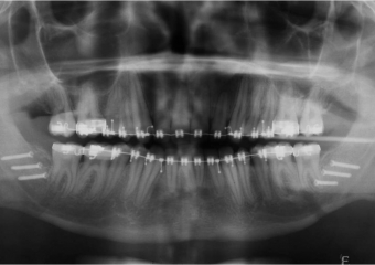 Raio x após cirurgia - Clínica Cliniface