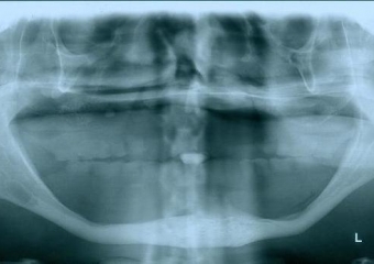 Raio - x Panorâmico inicial, em Julho de 2015 - Clínica Cliniface