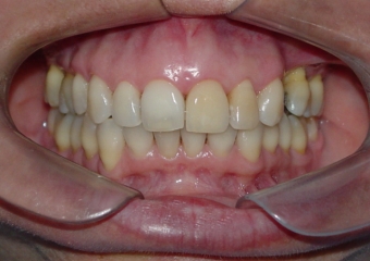 Imagens iniciais, observando a ausência do pré molar superior  - Clínica Cliniface