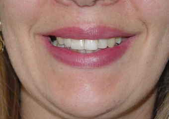 Sorriso final - Clínica Cliniface