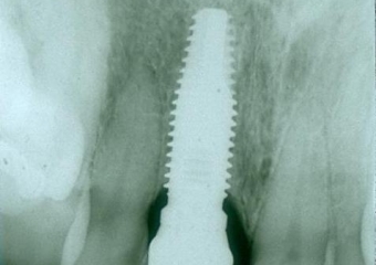 Raio X de controle realizado em agosto de 2013 - Clínica Cliniface