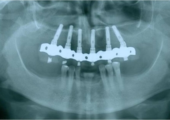 Raio X de controle, realizado em Junho de 2013 - Clínica Cliniface