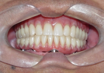 Prótese fixa inferior em resina - Clínica Cliniface