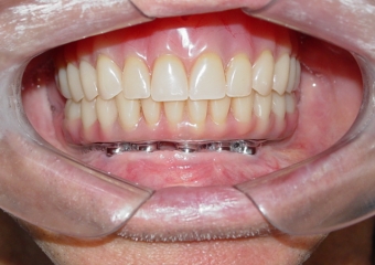 Prótese fixa em resina - Clínica Cliniface