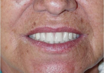 Sorrisos finais, do caso terminado em Maio de 2007 - Clínica Cliniface