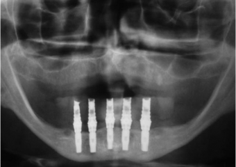 Raio X com os implantes instalados - Clínica Cliniface