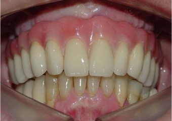 Prótese fixa em porcelana instalada - Clínica Cliniface