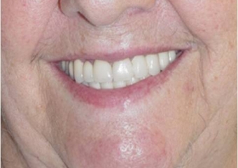 Sorriso final, do caso terminado em Junho de 2006 - Clínica Cliniface