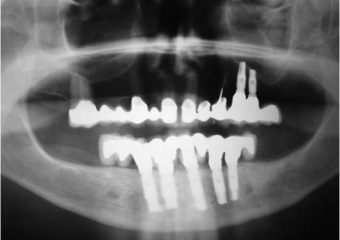 Raio X de controle, realizado em Setembro de 2008 - Clínica Cliniface