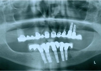 Raio X de controle, realizado em Março de 2012 - Clínica Cliniface