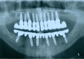 Raio X de controle, realizado em Agosto de 2012 - Clínica Cliniface