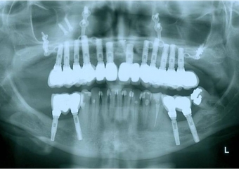 Raio X de controle, realizado em Março de 2012 - Clínica Cliniface