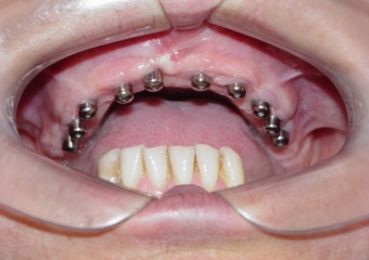 Implantes instalados com cicatrizadores - Clínica Cliniface