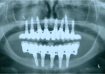 Raio X de controle, realizado em Abril de 2013 - Clínica Cliniface