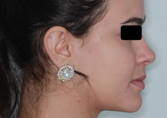 Perfil após a cirurgia - Clínica Cliniface