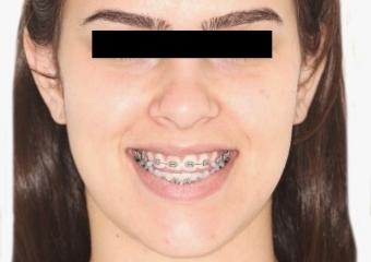 Sorriso inicial - Clínica Cliniface