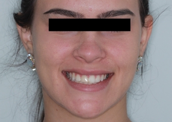 sorriso após a cirurgia - Clínica Cliniface